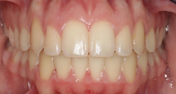 braces in irving