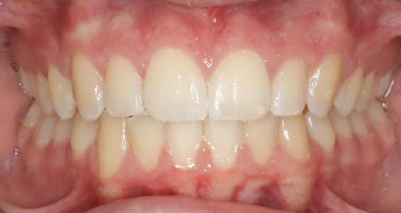 braces in irving