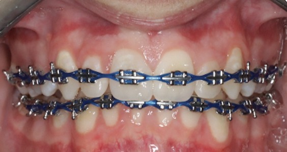 braces in irvingbraces in irving